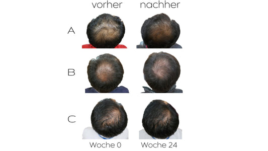 Natuerliches-Mittel-gegen-Haarausfall