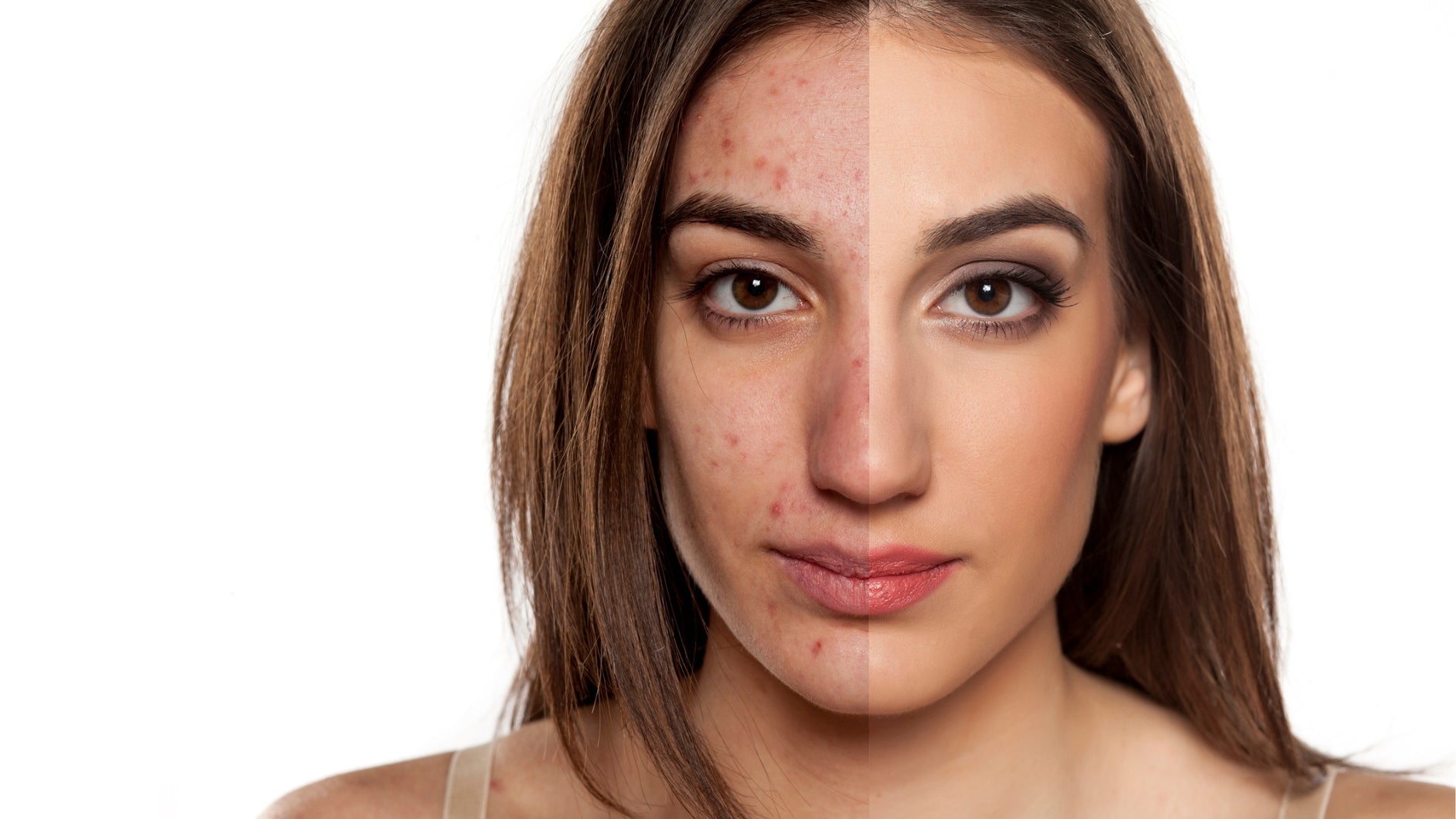 Natürliches Wundermittel gegen unreine Haut, Pickel, Mitesser, Akne. Traubenkernöl für strahlenden Haut mit Anti-Aging-Effekt