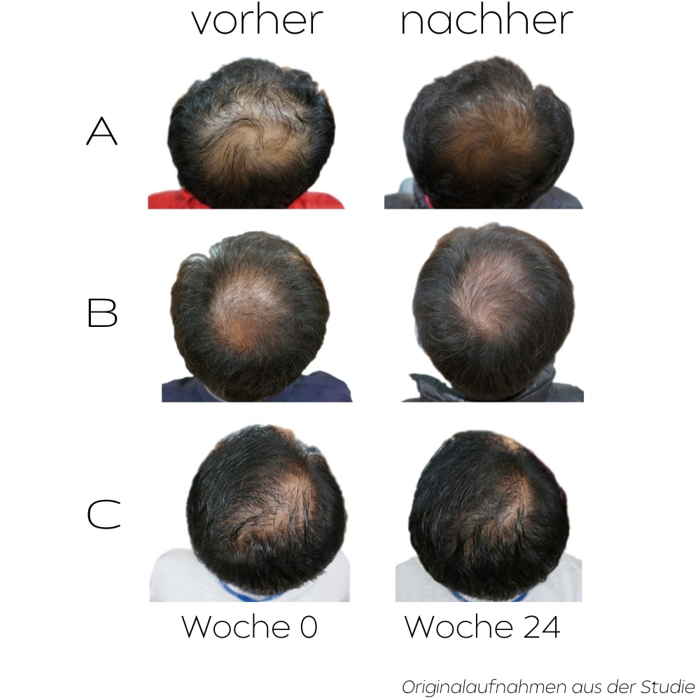 Mittel-gegen-Haarausfall