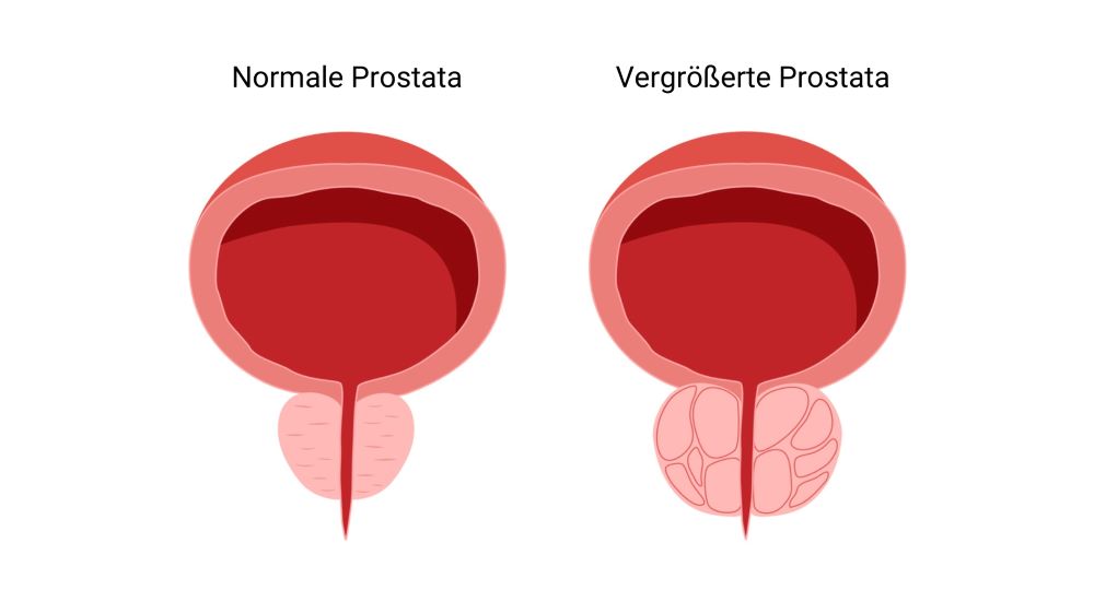 vergroesserte_Prostata